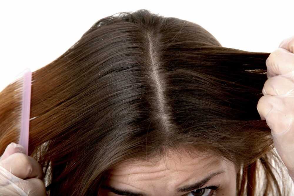 Da đầu bẩn là một trong những nguyên nhân gây ra gàu