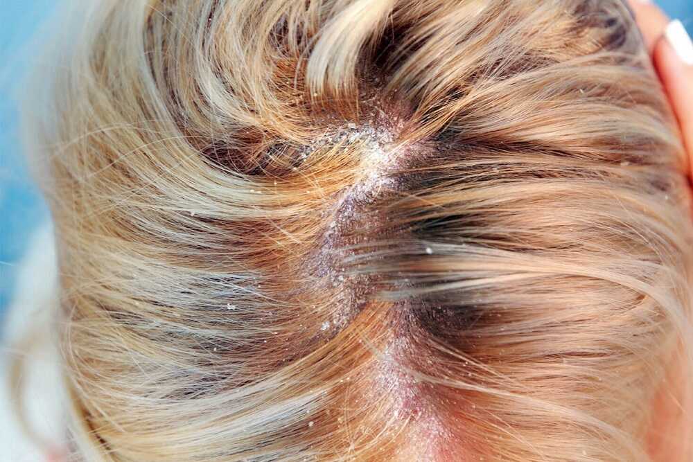 Nấm da đầu có thể điều trị tại nhà