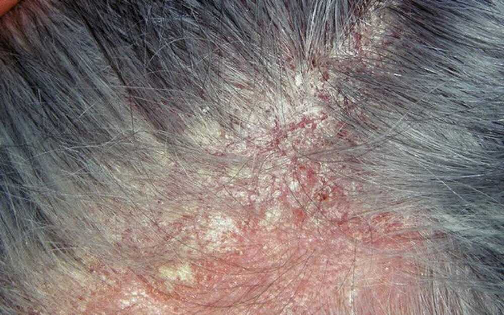 Nấm da đầu là bệnh lý do các vi nấm gây nên
