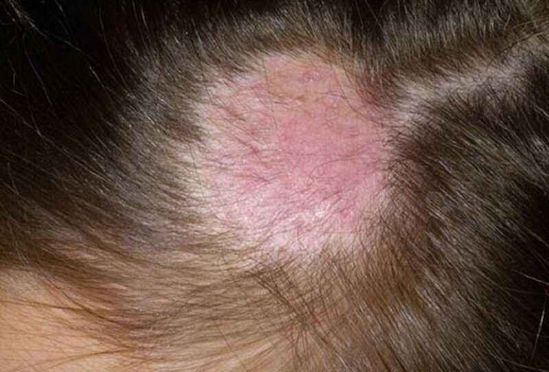 Nấm da đầu ở trẻ do nhiều chủng nấm gây nên