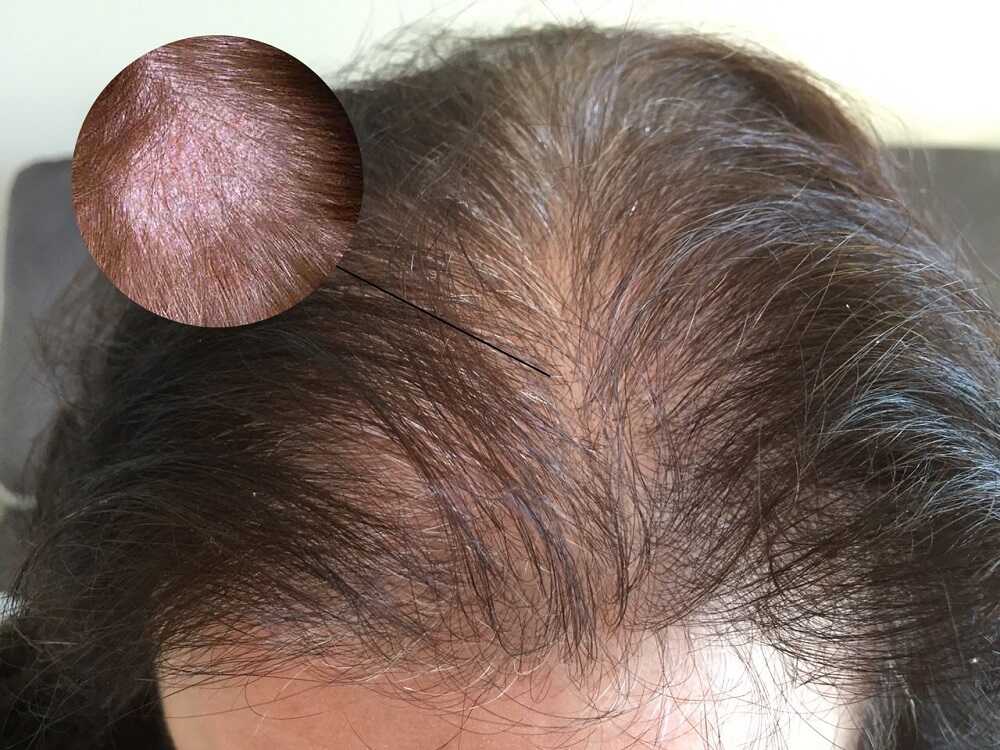 Nấm da đầu do 2 loại chủng nấm gây ra