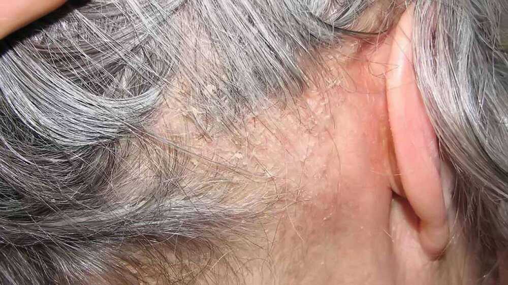 Gàu là tiền đề để các bệnh liên quan đến nấm da đầu phát triển